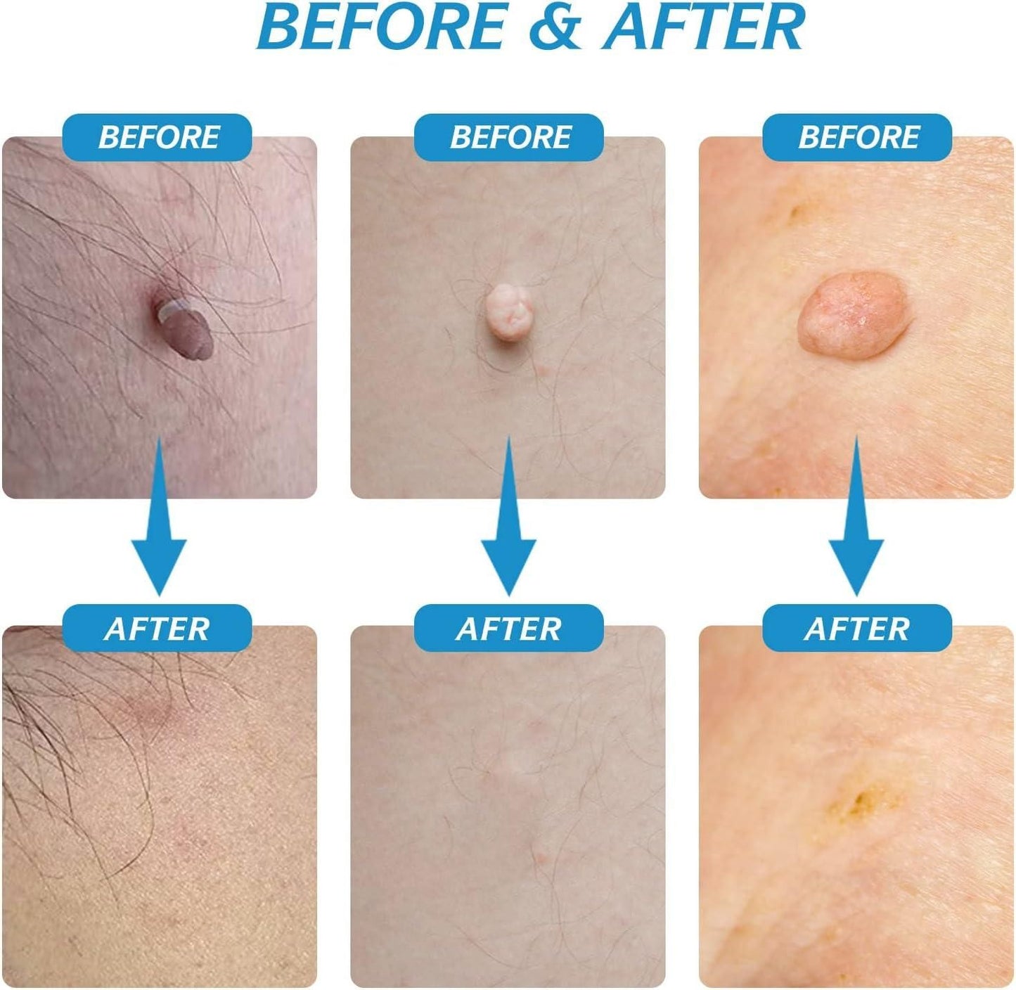 Skin Tag Painless Remover Kit