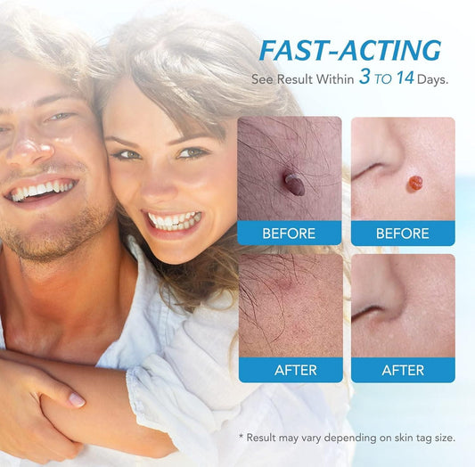 Skin Tag Painless Remover Kit